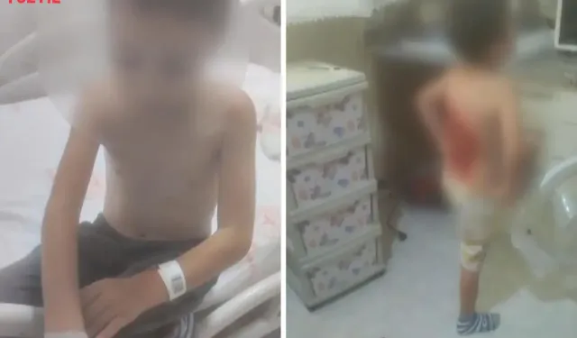 12 Yaşındaki Çocuğu Kolonya Döküp Yaktılar