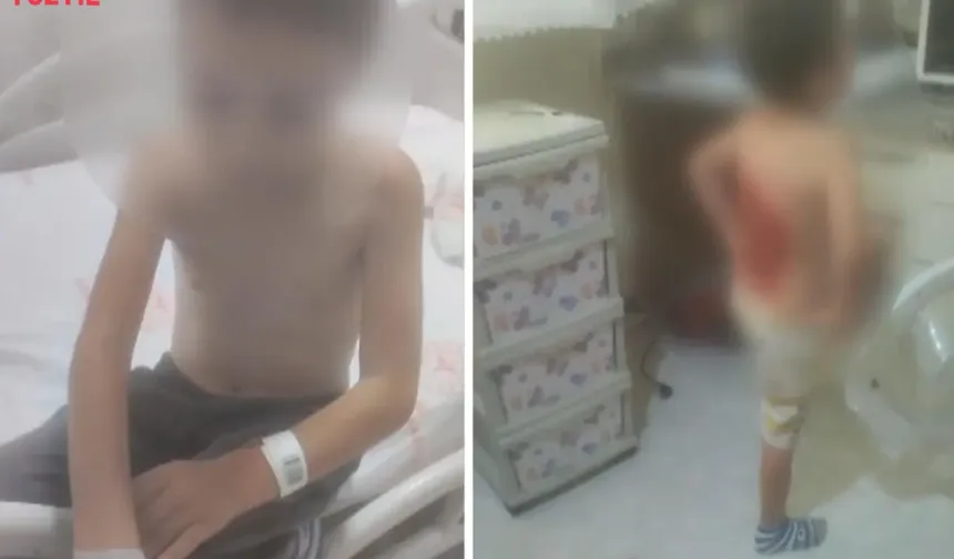 12 Yaşındaki Çocuğu Kolonya Döküp Yaktılar